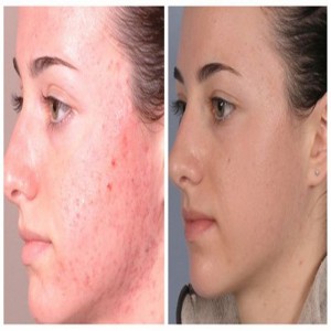 Forró eladás Microdermabrasion Diamond Peeling Beauty Machine gyár közvetlen értékesítése