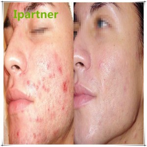 Forró eladás Derma Roller bőrápoláshoz